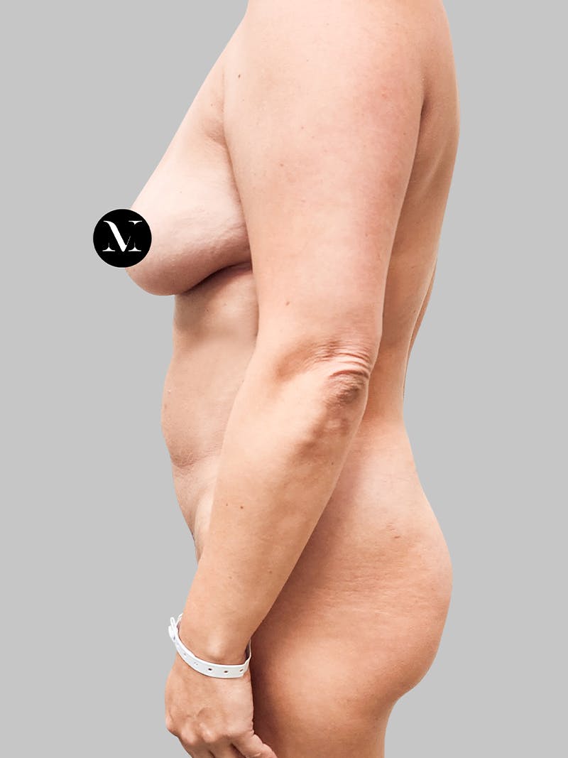 Tummy Tuck Patient 187993366 Before Left Side