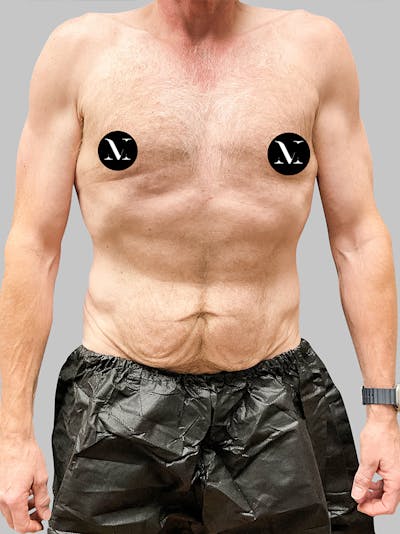 Tummy Tuck Patient 187993373 Before Front
