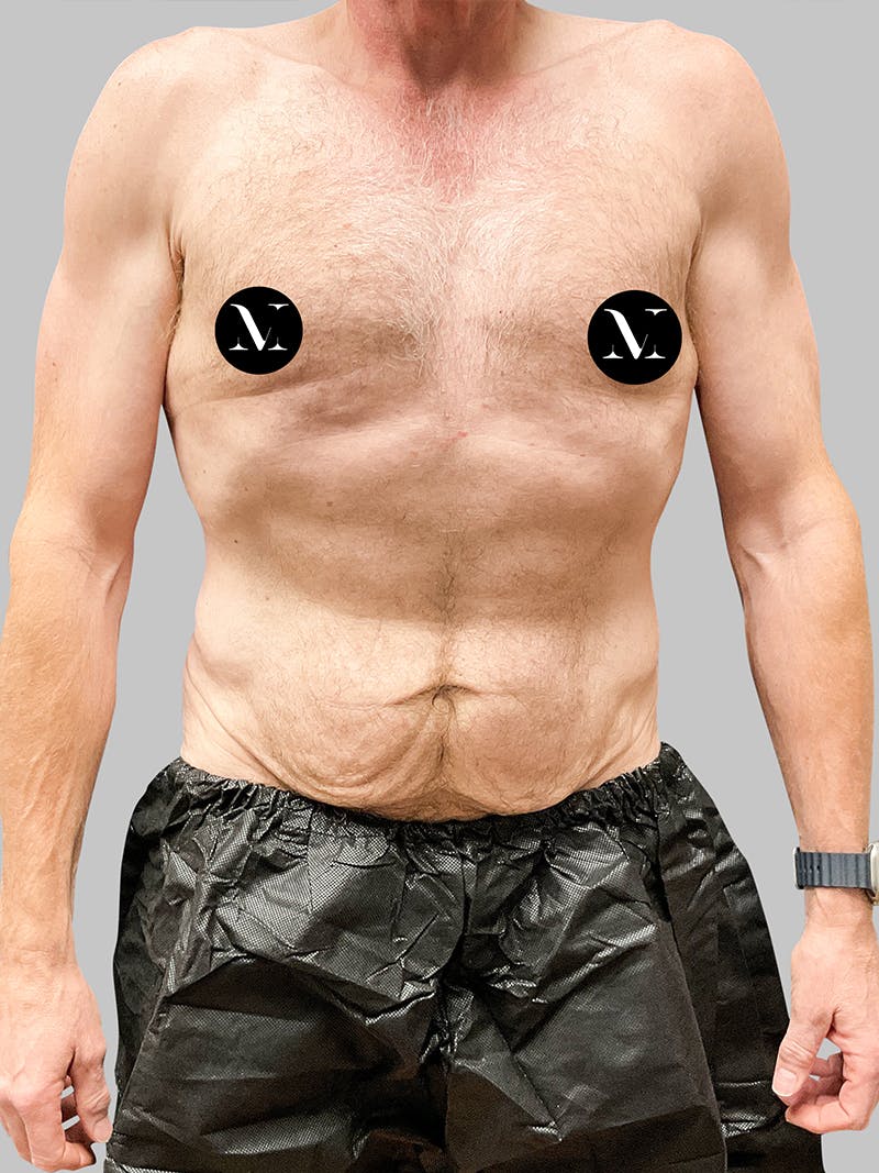 Tummy Tuck Patient 187993373 Before Front