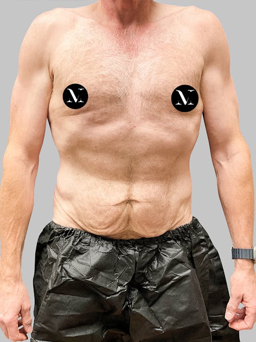 Tummy Tuck Patient 187993373 Before Front