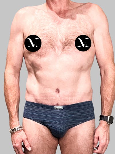 Tummy Tuck Patient 187993373 After Front