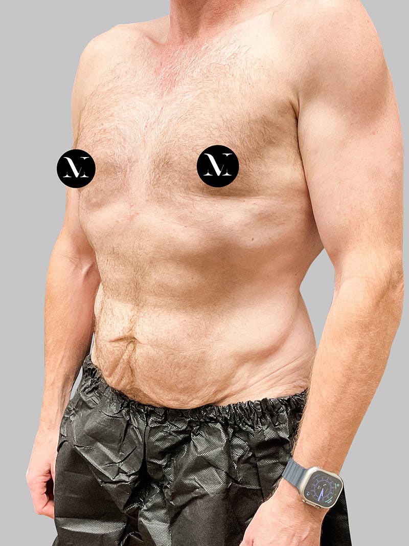 Tummy Tuck Patient 187993373 Before Left Angle