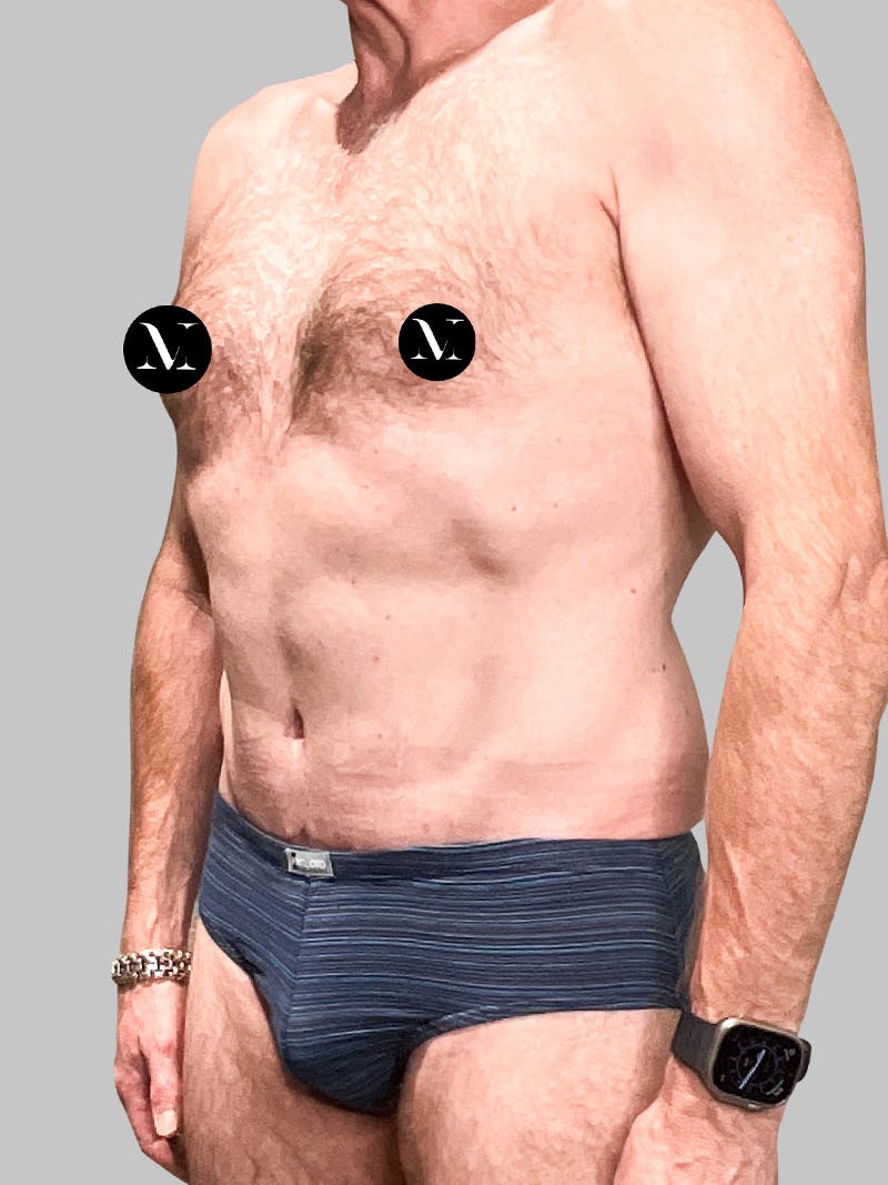 Tummy Tuck Patient 187993373 After Left Angle