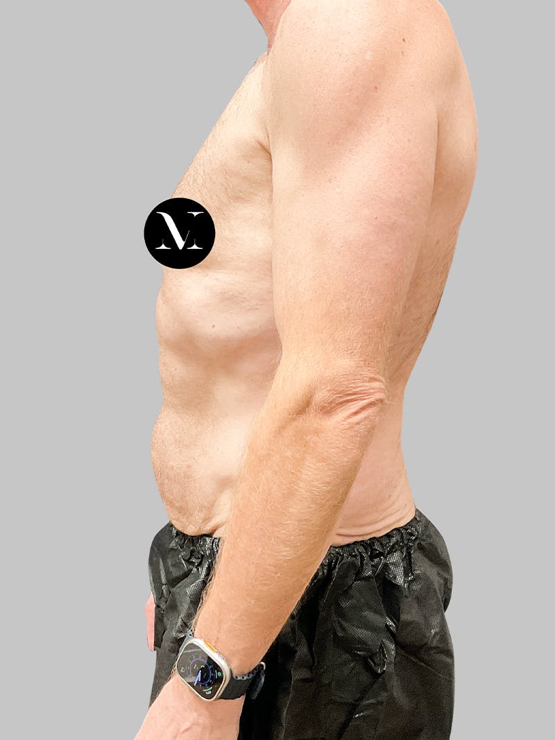 Tummy Tuck Patient 187993373 Before Left Side