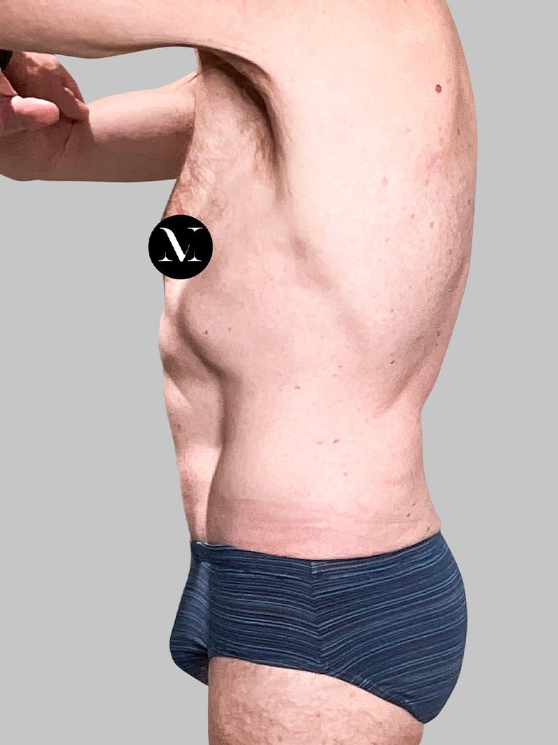 Tummy Tuck Patient 187993373 After Left Side