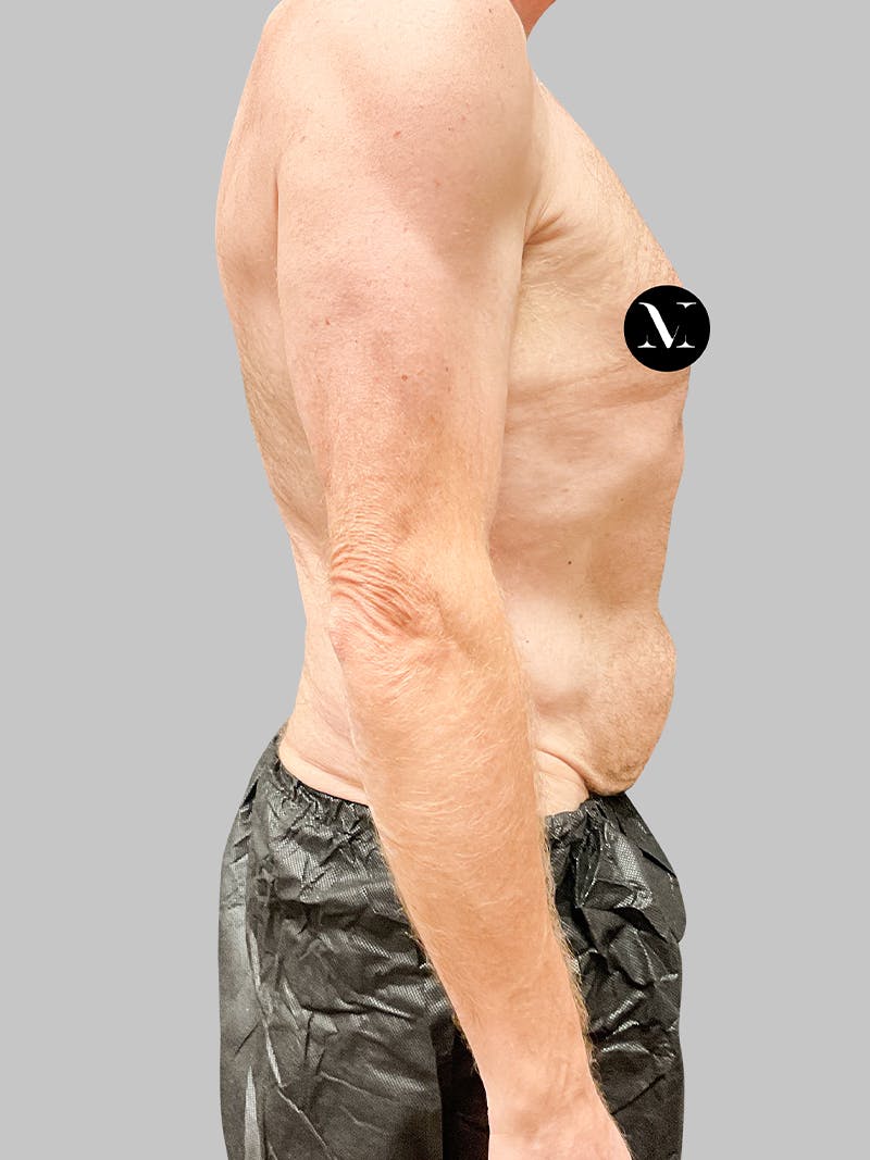 Renuvion Skin Tightening Before & After Gallery - Patient 187994315 - Image 7