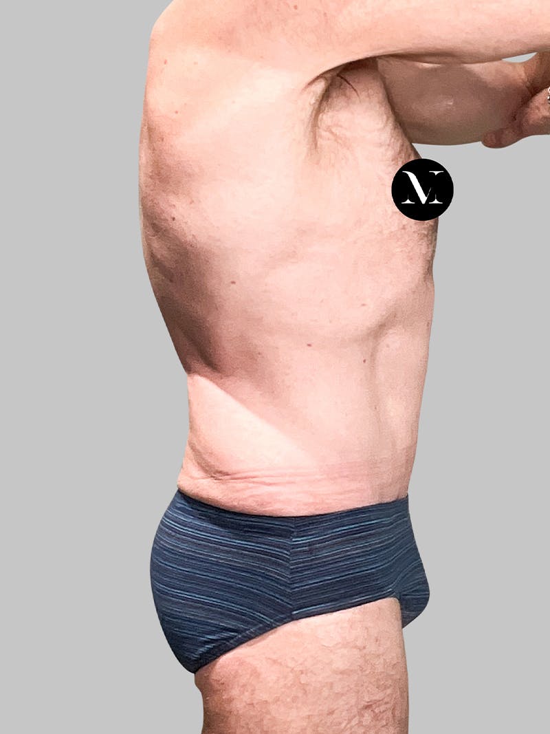 Renuvion Skin Tightening Before & After Gallery - Patient 187994315 - Image 8