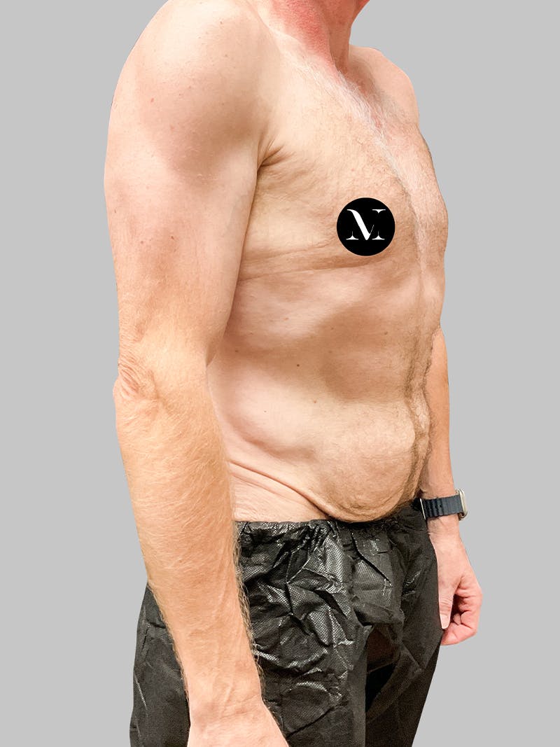 Renuvion Skin Tightening Before & After Gallery - Patient 187994315 - Image 9