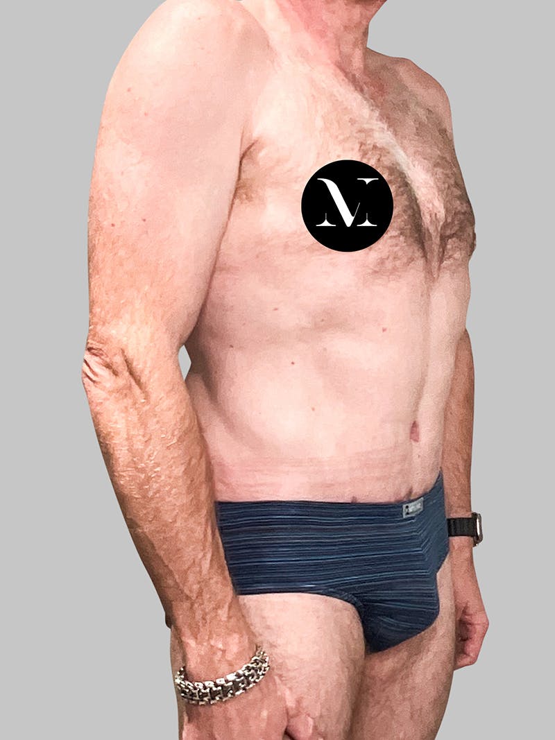 Renuvion Skin Tightening Before & After Gallery - Patient 187994315 - Image 10