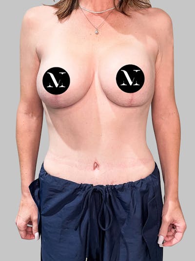 Tummy Tuck Patient 187993377 After Front