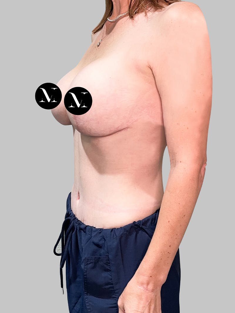 Tummy Tuck Patient 187993377 After Left Angle