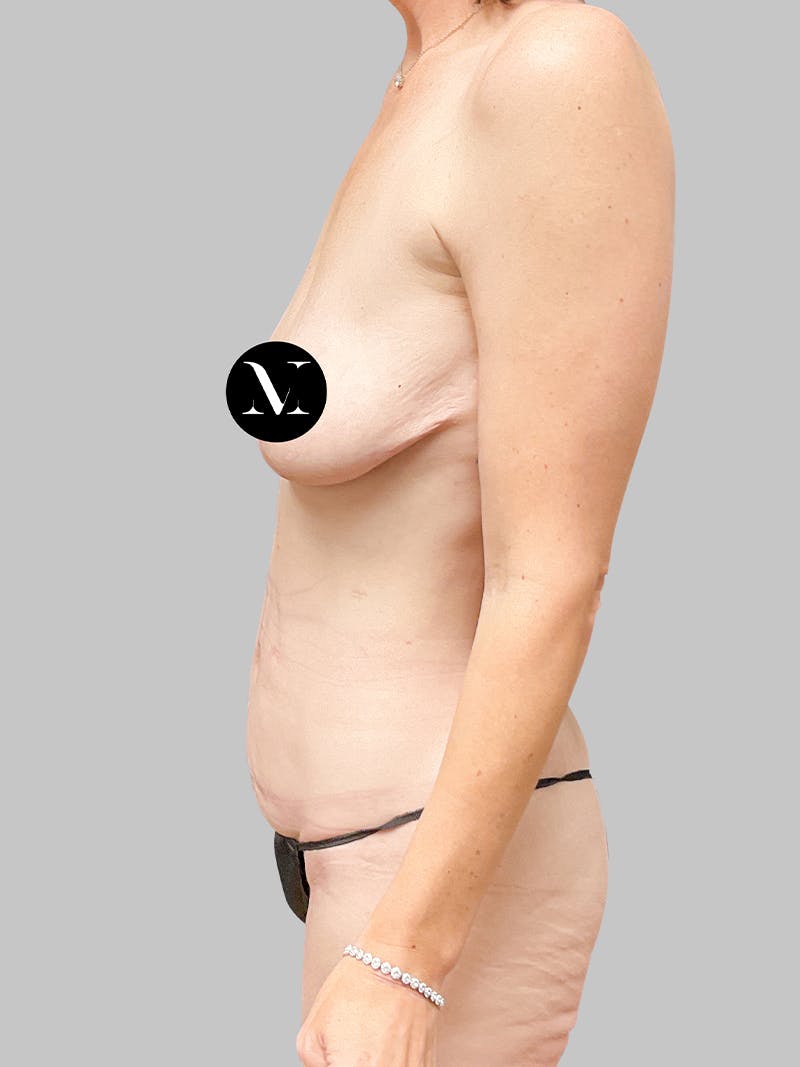 Tummy Tuck Patient 187993377 Before Left Side