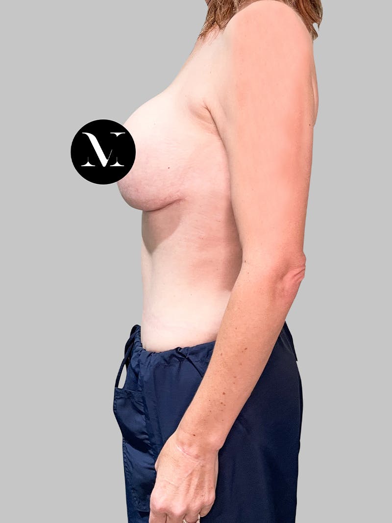 Tummy Tuck Patient 187993377 After Left Side