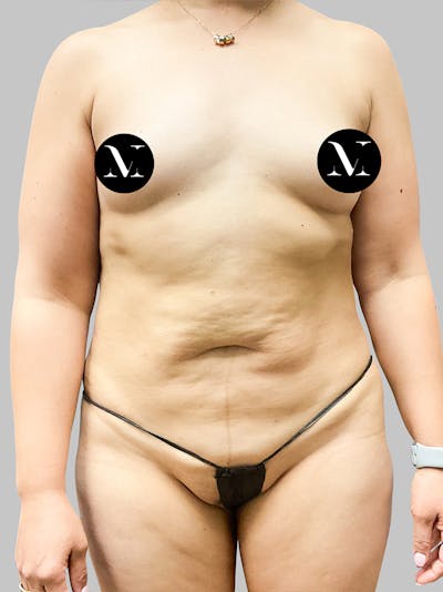 Tummy Tuck Patient 189383427 Before Front