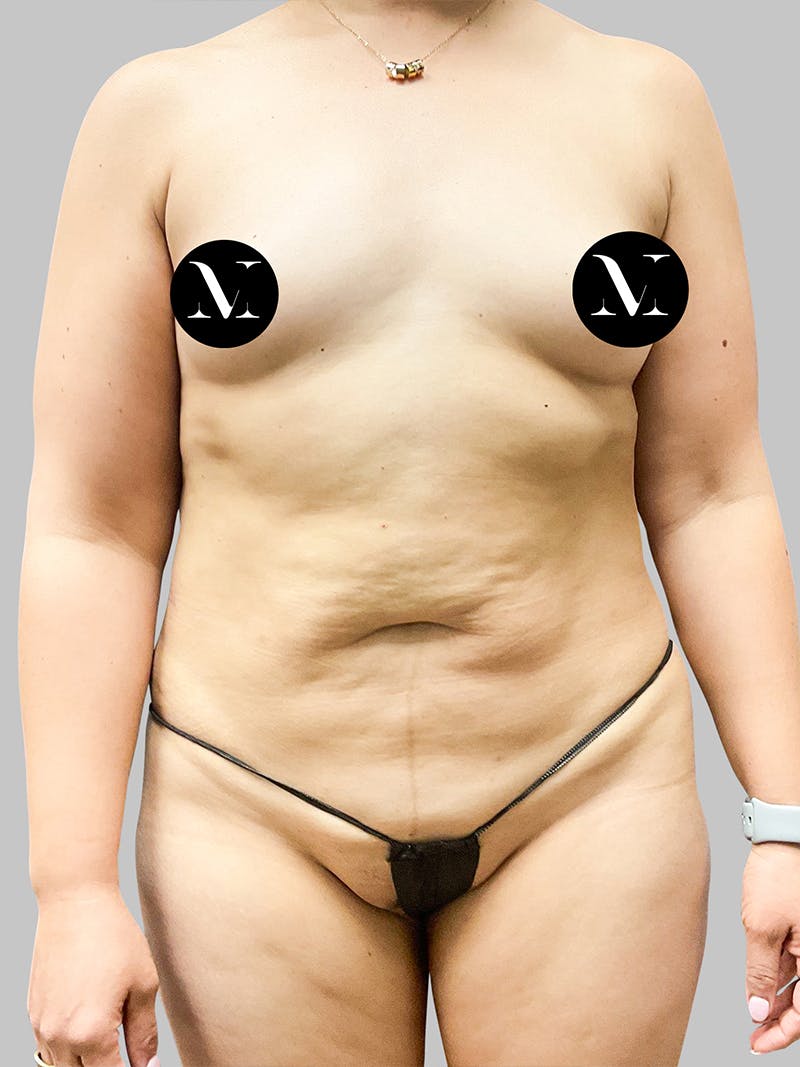 Tummy Tuck Patient 189383427 Before Front