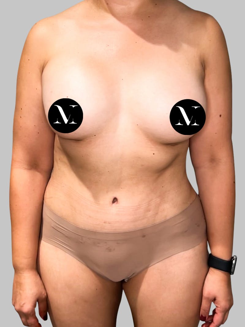 Tummy Tuck Patient 189383427 After Front