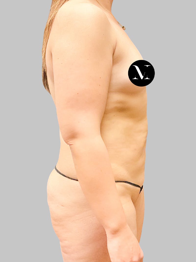 Tummy Tuck Patient 189383427 Before Right Side