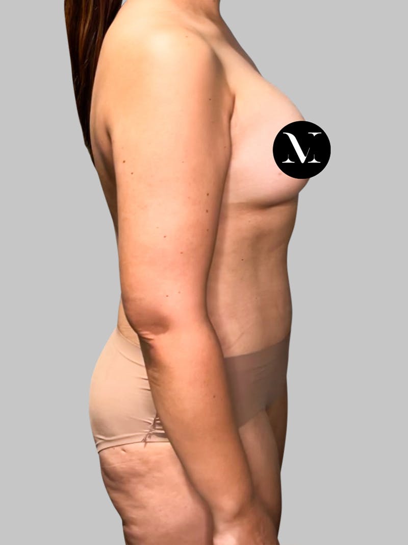 Tummy Tuck Patient 189383427 After Right Side