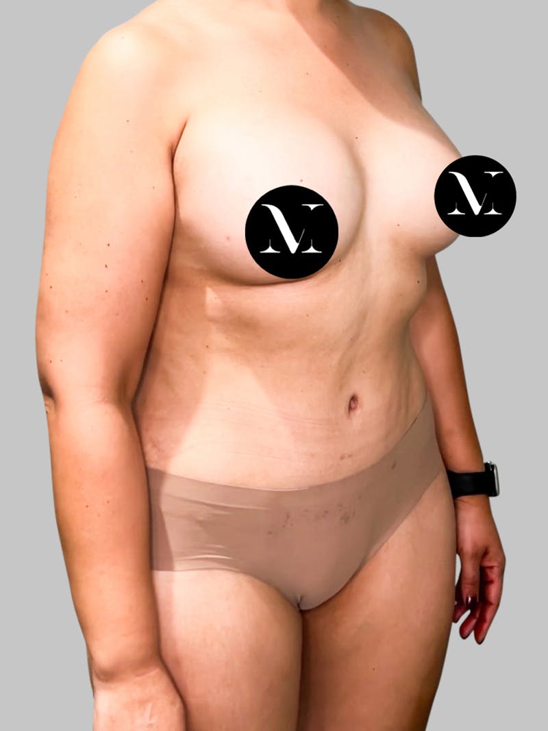 Tummy Tuck Patient 189383427 After Right Angle