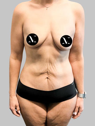 Tummy Tuck Patient GI4qcMe8SLGDJ09kr45G7w Before Front