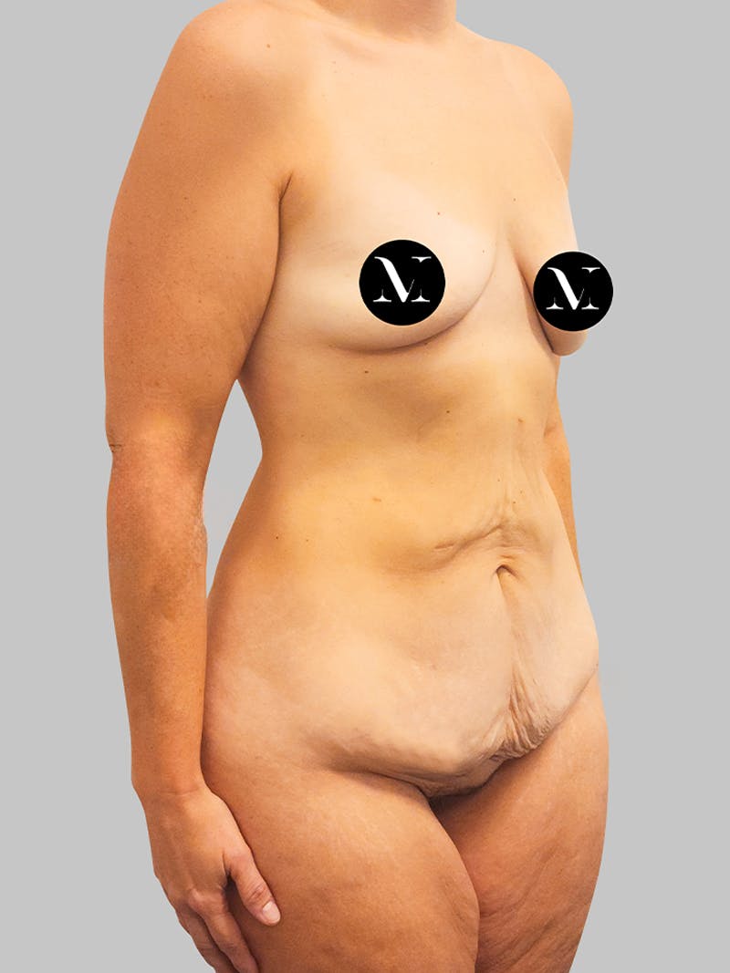 Tummy Tuck Patient GI4qcMe8SLGDJ09kr45G7w Before Right Angle