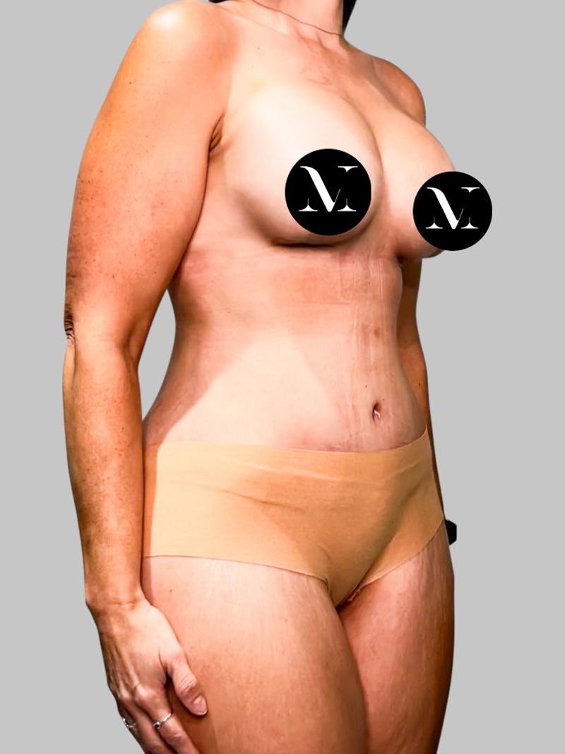 Tummy Tuck Patient GI4qcMe8SLGDJ09kr45G7w After Right Angle