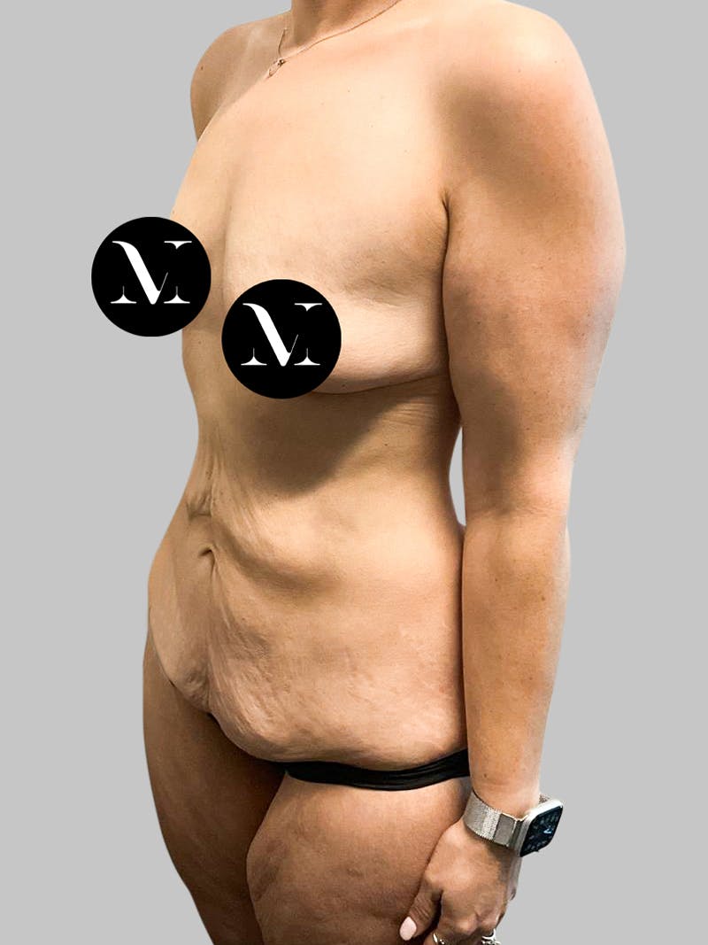 Tummy Tuck Patient GI4qcMe8SLGDJ09kr45G7w Before Left Angle