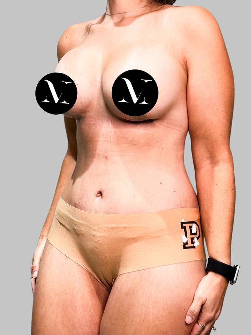 Tummy Tuck Patient GI4qcMe8SLGDJ09kr45G7w After Left Angle