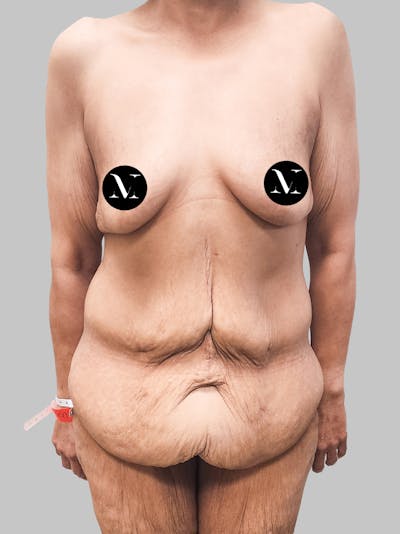 Lower Body Lift Before & After Gallery - Patient 187996795 - Image 1