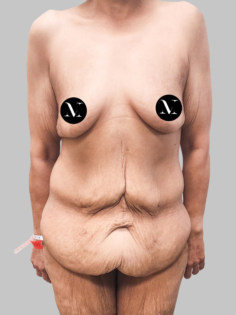 Lower Body Lift Before & After Gallery - Patient 187996795 - Image 1