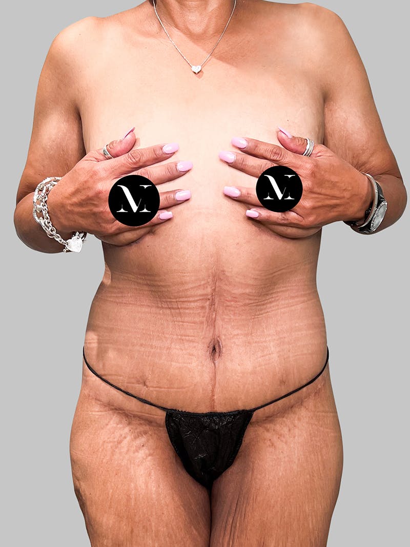 Lower Body Lift Before & After Gallery - Patient 187996795 - Image 2