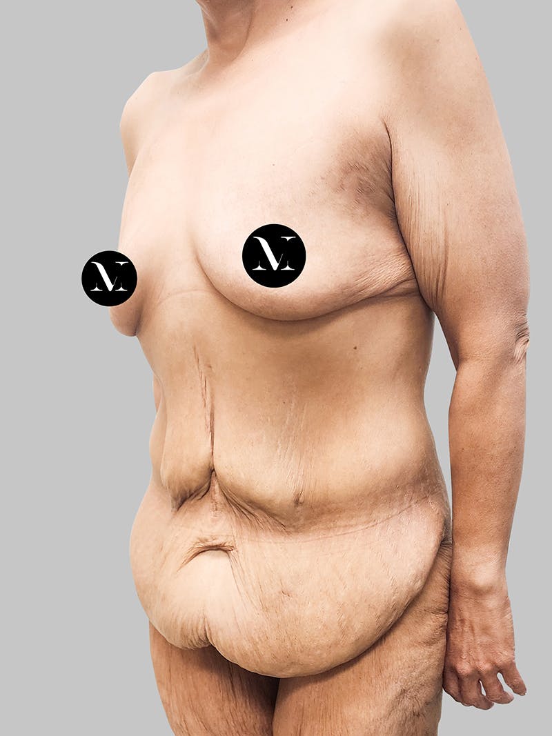 Lower Body Lift Before & After Gallery - Patient 187996795 - Image 3