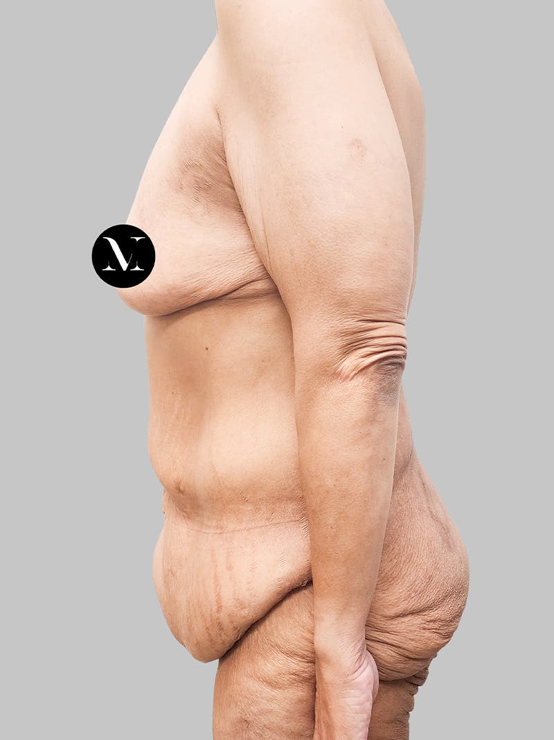Lower Body Lift Before & After Gallery - Patient 187996795 - Image 5