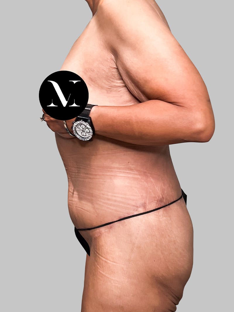 Lower Body Lift Before & After Gallery - Patient 187996795 - Image 6