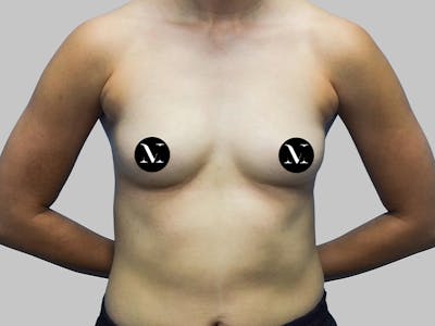 Breast Augmentation Before & After Gallery - Patient 187989833 - Image 1