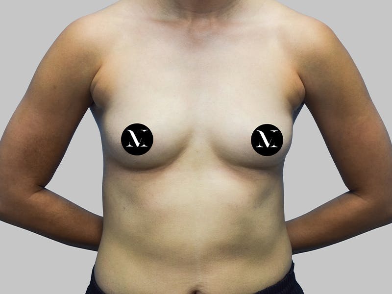Breast Augmentation Before & After Gallery - Patient 187989833 - Image 1