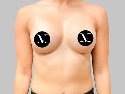 Breast Augmentation Before & After Gallery - Patient 187989833 - Image 2