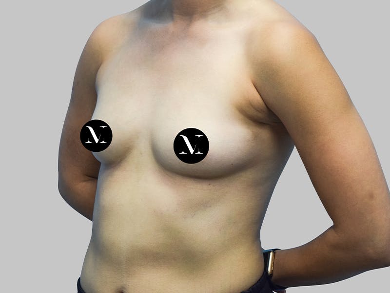 Breast Augmentation Before & After Gallery - Patient 187989833 - Image 3