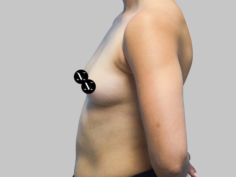 Breast Augmentation Before & After Gallery - Patient 187989833 - Image 5