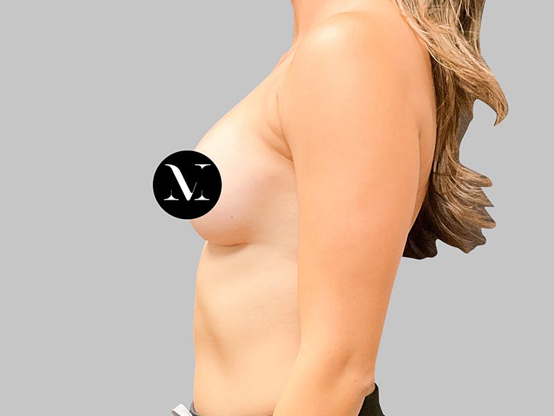 Breast Augmentation Before & After Gallery - Patient 187989833 - Image 6