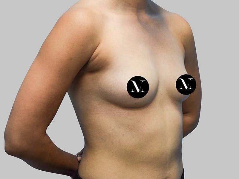 Breast Augmentation Before & After Gallery - Patient 187989833 - Image 9