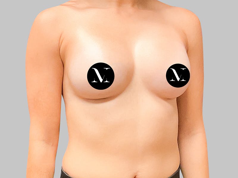 Breast Augmentation Before & After Gallery - Patient 187989833 - Image 10
