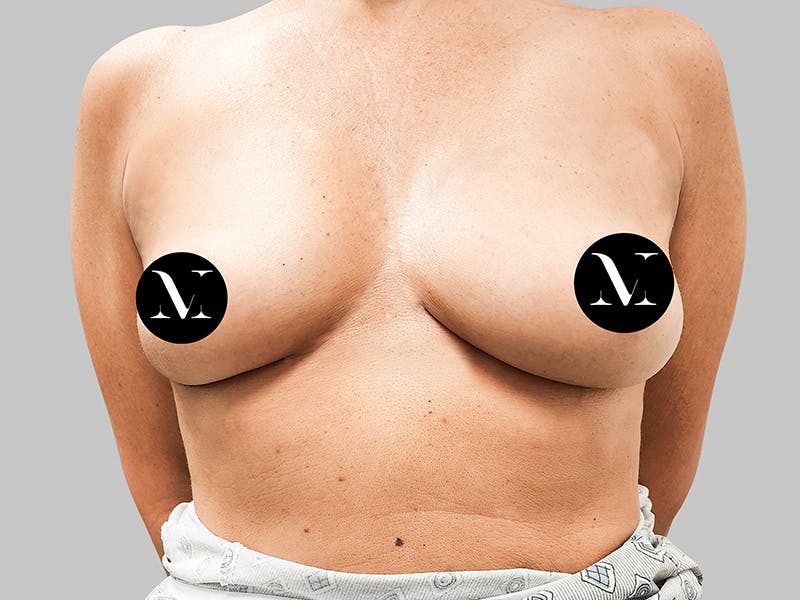 Breast Augmentation Before & After Gallery - Patient 187989836 - Image 1