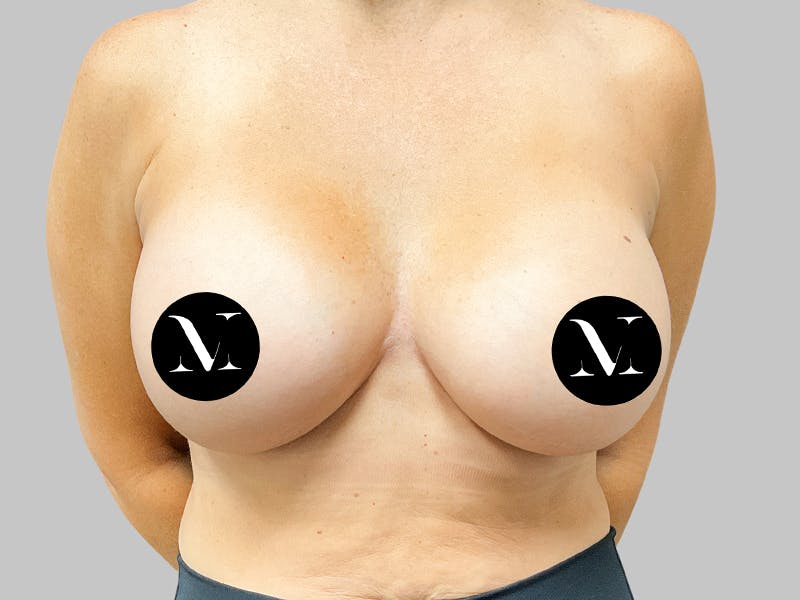 Breast Augmentation Before & After Gallery - Patient 187989836 - Image 2