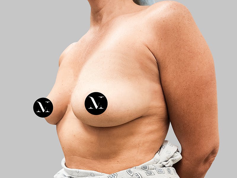 Breast Augmentation Before & After Gallery - Patient 187989836 - Image 3
