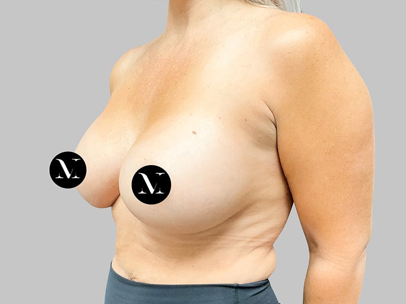 Breast Augmentation Before & After Gallery - Patient 187989836 - Image 4