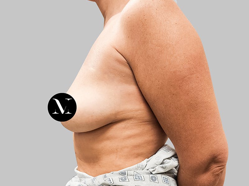 Breast Augmentation Before & After Gallery - Patient 187989836 - Image 5