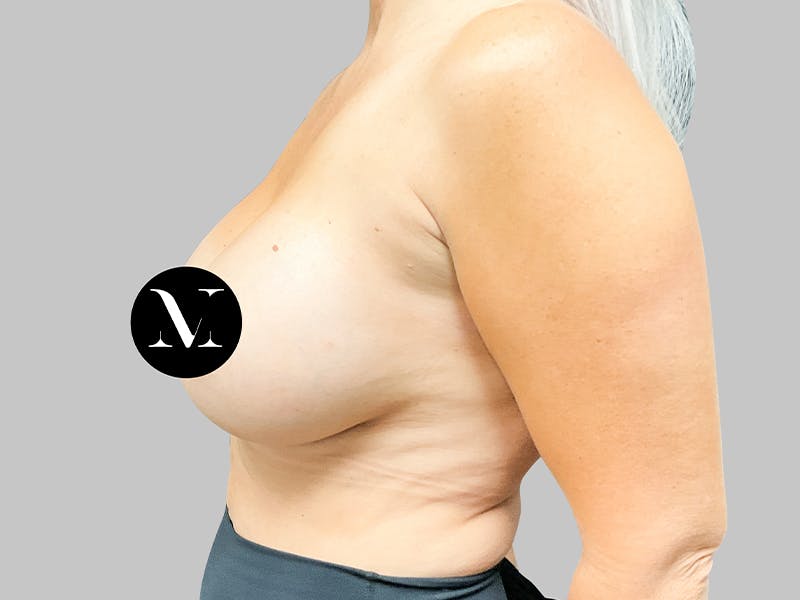 Breast Augmentation Before & After Gallery - Patient 187989836 - Image 6