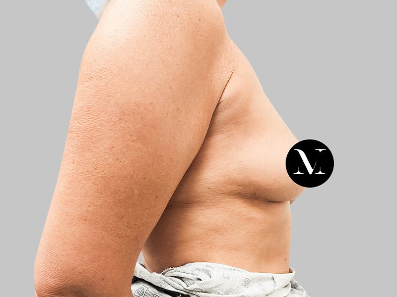 Breast Augmentation Before & After Gallery - Patient 187989836 - Image 7