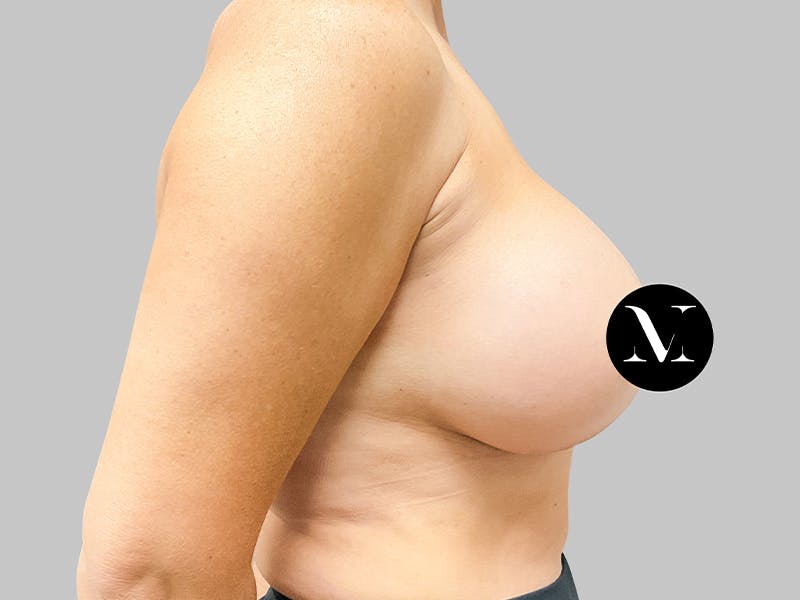 Breast Augmentation Before & After Gallery - Patient 187989836 - Image 8